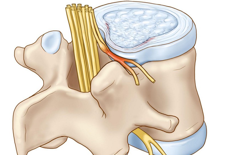 Фораминальная протрузия