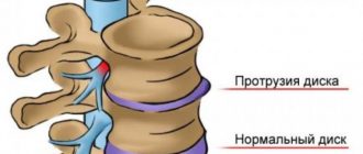 Протрузия позвоночного диска