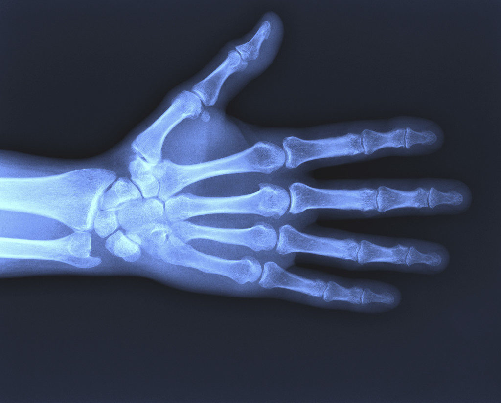 Ушиб кисти рук рентген