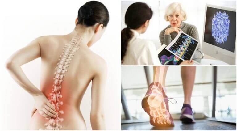 симптомы остеопороза