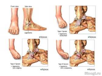 Степени растяжения связок стопы