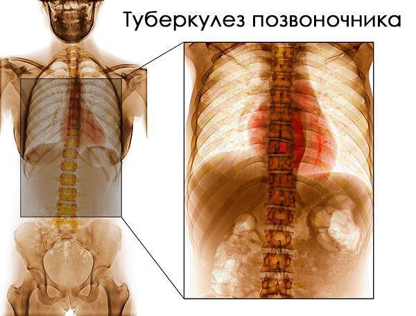 Туберкулез позвоночника: причины заболевания, основные симптомы, лечение и профилактика