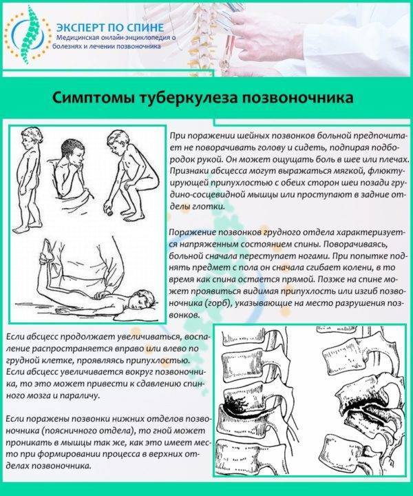 Туберкулез позвоночника: причины заболевания, основные симптомы, лечение и профилактика