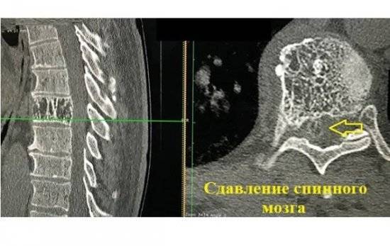 Гемангиома позвоночника