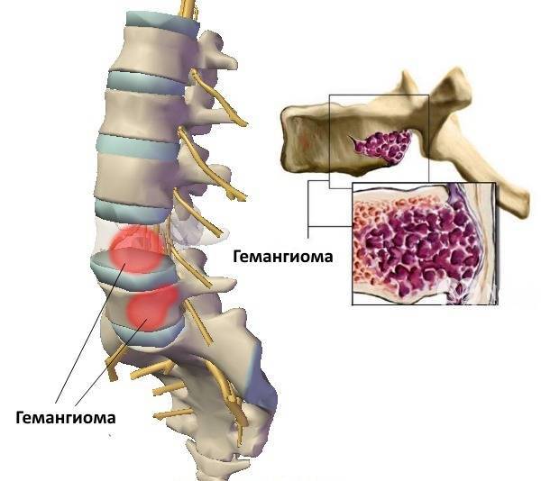 Гемангиома позвоночника