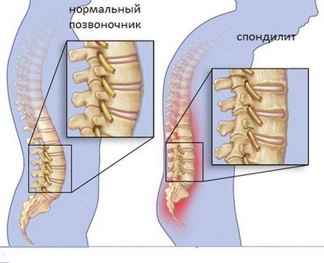 Болезнь бехтерева у женщин: симптомы и лечение болезни