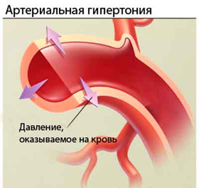 arterialnaja-gipertonia_250