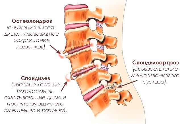 spondylosis-spinal