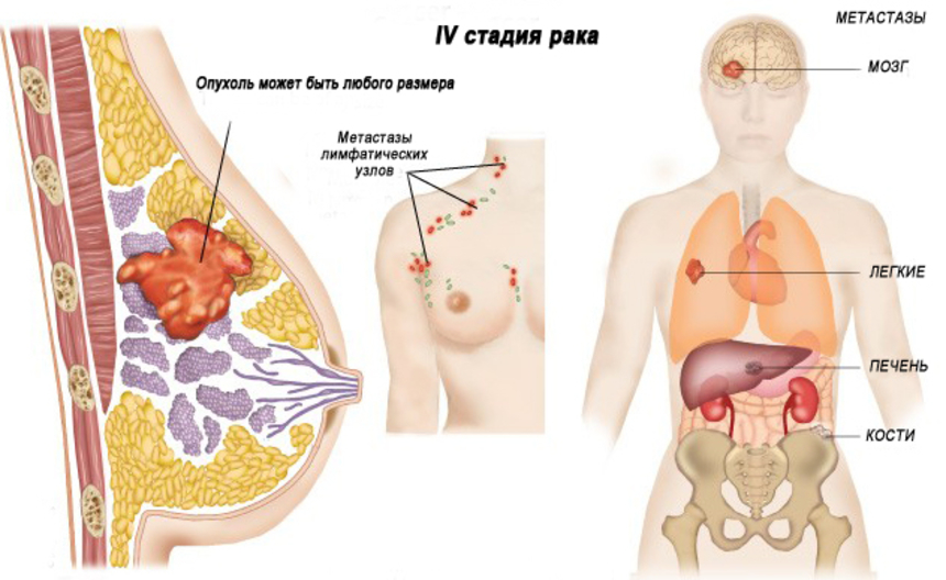 Симптомы 4 стадии рака груди: опухоль гигантских размеров