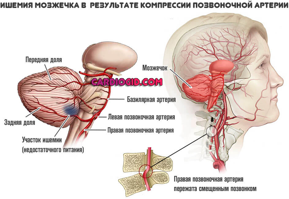 ишемия-мозжечка-в-результате-остеохондроза