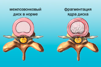 Межпозвонковый диск при остеохондрозе