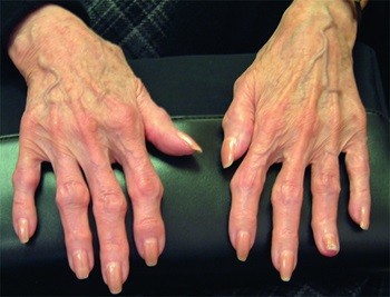 Остеоартрит на суставах пальцев, фото