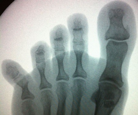 Рентген снимок перелома мизинца на ноге