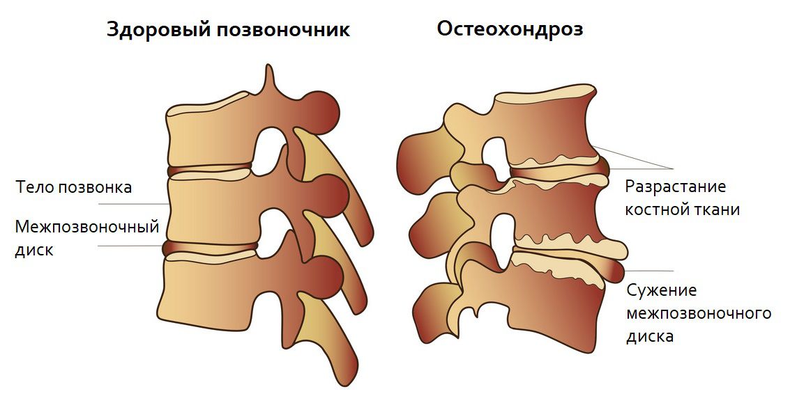 Остеохондроз