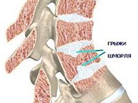 Причины грыжи Шморля