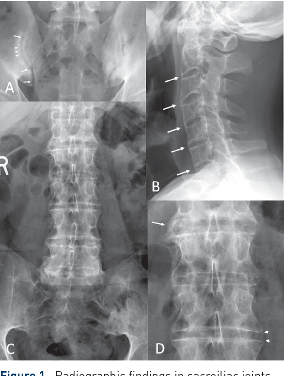 Болезнь бехтерева. Анкилозирующий спондилоартрит рентген. Анкилозирующий спондилит рентген. Анкилозирующий спондилит рентген позвоночника. Болезнь Бехтерева рентген сакроилеит.
