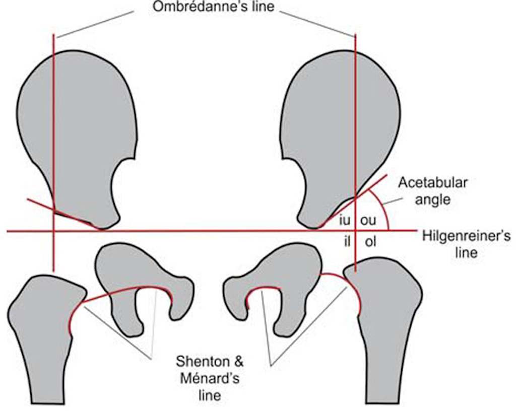 Схема Hilgenreiner для диагностики дисплазии тазобедренного сустава