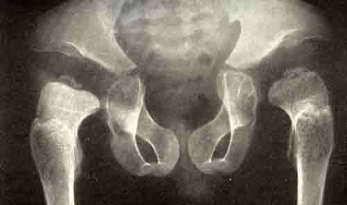 Рентгеновский снимок малыша с дисплазией