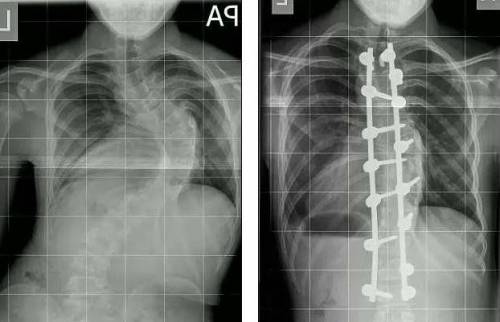 Рентгенограмма до и после коррекции искривления позвоночника