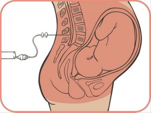 Эпидуральная анестезия при беременности