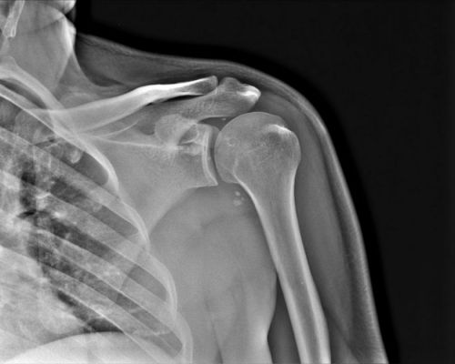 Рентген плечевого сустава