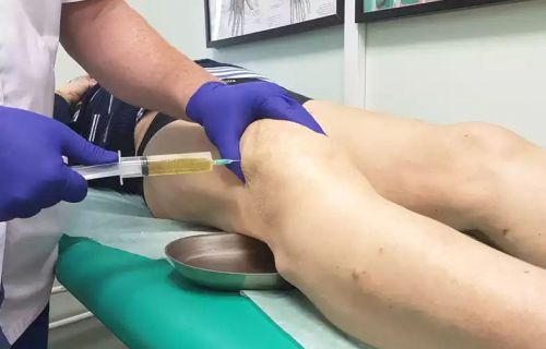 Удаление жидкости из колена