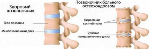 Позвоночник при остеохондрозе