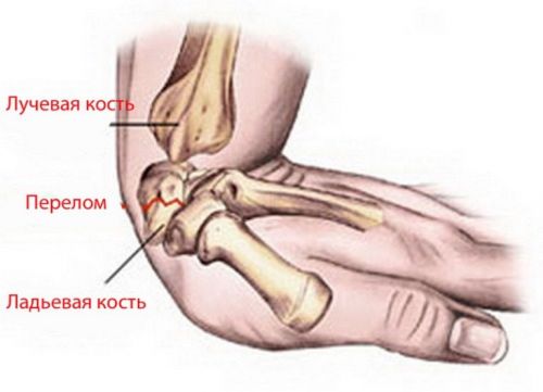 Перелом запястья