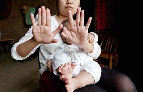 Мама и ребенок с аномалиями пальцев