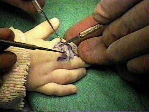 Операция на пальцах