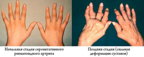 Деформация пальцев