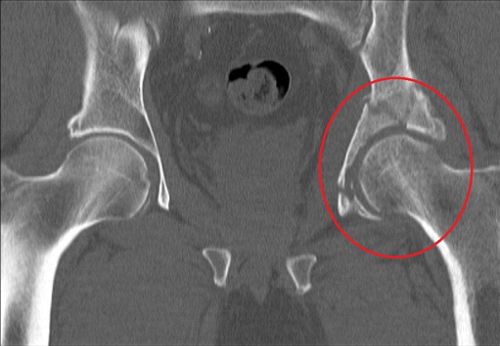 КТ-снимок перелома вертлужной впадины