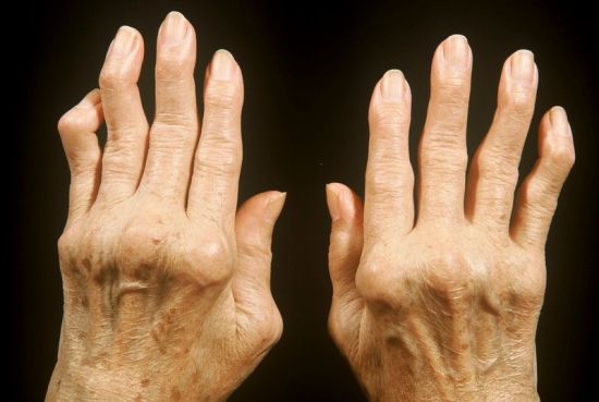 Покрученные суставы на пальцах рук