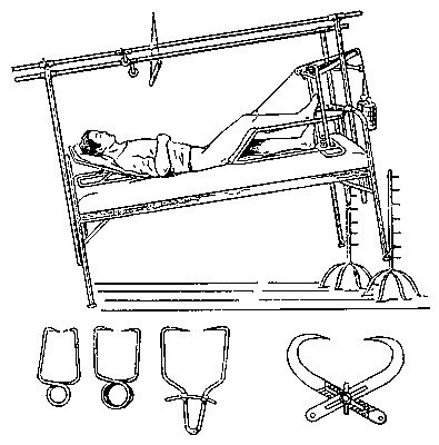 Рис. 1. Вверху — скелетное вытяжение при переломе бедра; внизу — клеммы для скелетного вытяжения.