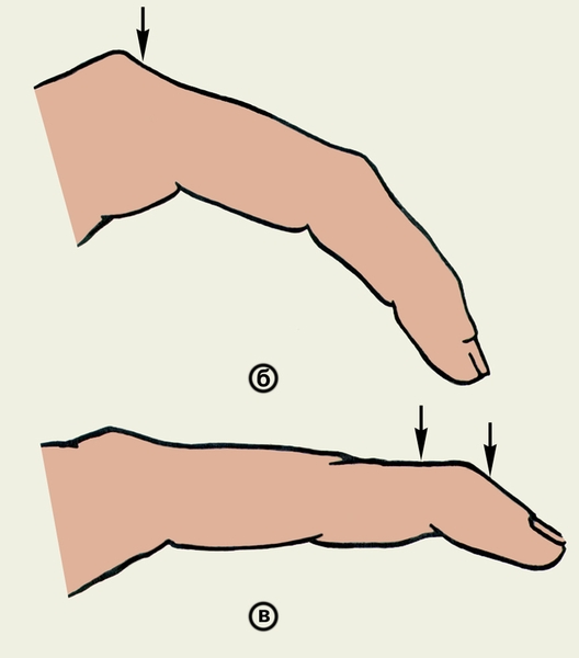 Рис. 5б,в). Схематическое изображение деформаций пальцев кисти при повреждениях сухожилий сгибателей на различных уровнях: б — на уровне основной фаланги пальца; в — на уровне дистального межфалангового сустава; уровни повреждения сухожилий указаны стрелками