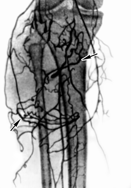 Рис. 2. Артериограмма голени и коленного сустава (прямая проекция) при злокачественной синовиоме: стрелками указана зона патологической гиперваскуляризации