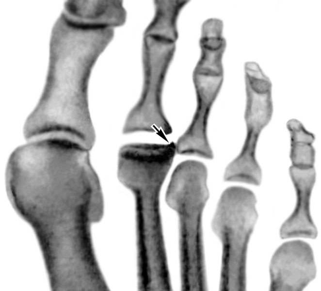 Рис. 2а). Рентгенограммы переднего отдела стоп больных с различными стадиями болезни Келера II (патологические изменения указаны стрелками): уплощение суставной головки II плюсневой кости