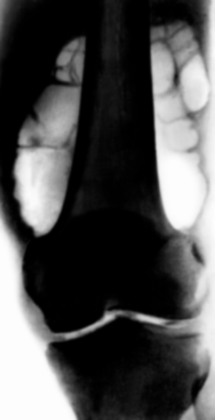Рис. 2б). Артропневмограмма коленного сустава (прямая проекция; левый сустав) при пигментно-виллезном синовите: размеры заворотов увеличены, стенки капсулы суставов утолщены, в их полости видны уплотнения нитевидной и узловой формы