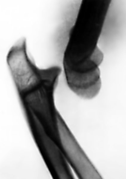 Рис. 3. Рентгенограмма локтевого сустава (боковая проекция) при заднем вывихе правого предплечья: локтевая и лучевая кости смещены кзади, их суставные поверхности не соприкасаются с блоком и головкой мыщелка плечевой кости