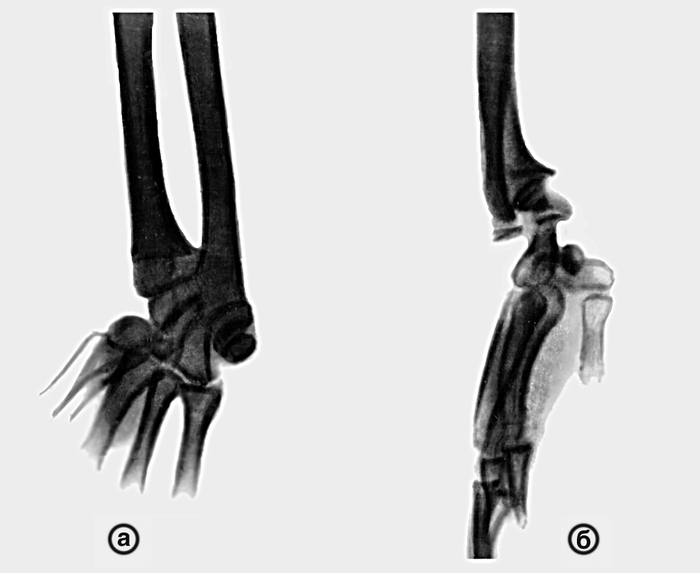 Рентгенограммы костей предплечья и лучезапястного сустава при болезни Маделунга в прямой (а) и боковой (б) проекциях: а — лучевая кость укорочена, ее <a href=