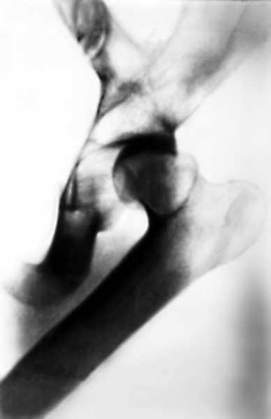 Рис. 4. Рентгенограмма тазобедренного сустава (прямая проекция) при передневерхнем вывихе левого бедра: головка бедренной кости находится вне вертлужной впадины у ее передневерхнего края