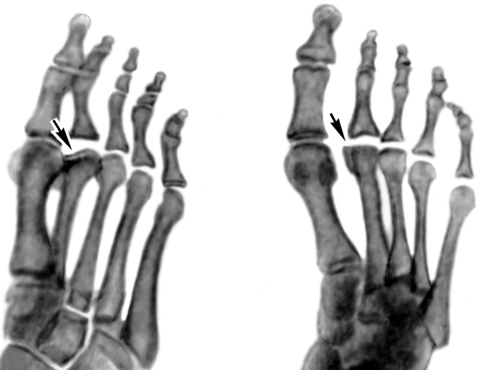Рис. 2в). Рентгенограммы переднего отдела стоп больных с различными стадиями болезни Келера II (патологические изменения указаны стрелками): деформирующий артроз II плюснефалангового сочленения (слева косая проекция)