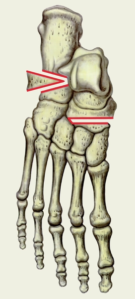 Рис. 3б). Схема основных этапов операции Пертеса при статическом продольном плоскостопии: иссеченный костный клин введен в место остеотомии