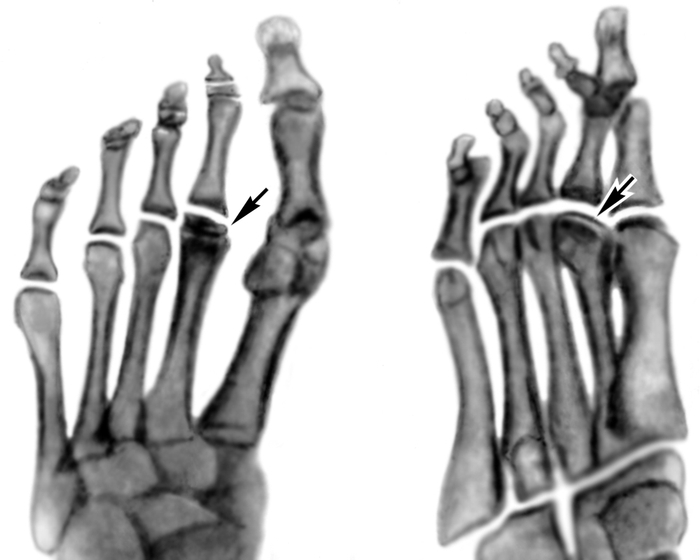 Рис. 2б). Рентгенограммы переднего отдела стоп больных с различными стадиями болезни Келера II (патологические изменения указаны стрелками): рассасывание и фрагментация головки II плюсневой кости (справа косая проекция)