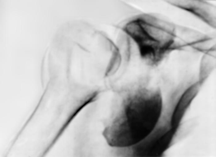 Рис. 1. Рентгенограмма плечевого сустава (прямая проекция) при переломовывихе правого плеча: фрагмент суставной поверхности головки плечевой кости находится вне суставной впадины у ее передненижнето отдела