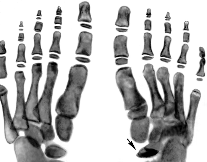 Рис. 1а). Рентгенограммы стоп ребенка 6 лет при болезни Келера I: в прямой проекции — ладьевидная кость правой стопы деформирована (указана стрелкой), состоит из отдельных плотных фрагментов; ладьевидная кость левой стопы не изменена