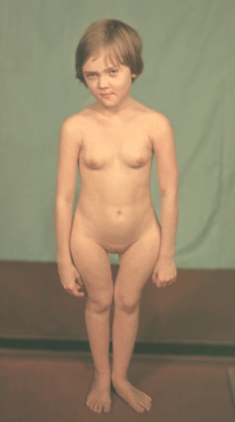 Рис. 1а). Девочка с полиоссальной формой фиброзной остеодисплазии: деформация бедер и укорочение нижних конечностей, <a href=