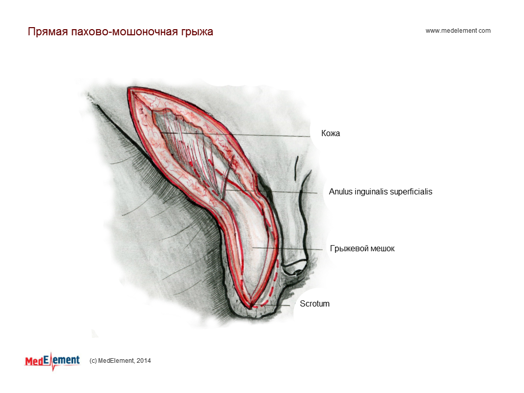 Прямая пахово-мошоночная грыжа