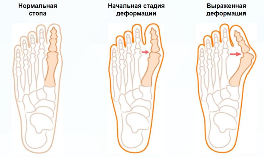 Вальгусная деформация стопы.jpg