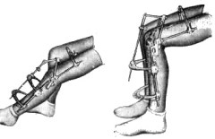 Лечение контрактуры коленного сустава